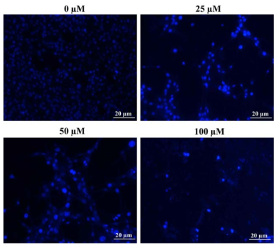 Hoechst staining analysis of β-amyloid treated SH-SY5Y cells