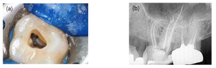 최소침습적 근관치료의 예. (a)최소한의 근관와동형성을 통해 치관부 치질을 최대한 보존한 임상 사진. (b)최소한의 근관형성을 통해 치근부 치질을 최대한 보존하여 치근파절을 예방하고 치아의 수명을 극대화 시킬 수 있음. 이를 위해서 강력한 근관소독과정이 요구되며 결국 영구 근관충전재에도 항균효과가 요구되는 상황임