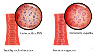 Bacterial vaginosis의 질내 서식균의 변화