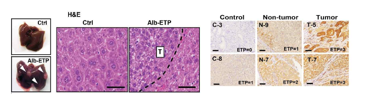Alb-ETP 생쥐 모델에 DEN 처리를 하여 간 손상을 유도함. H&E 염색법을 통해 대조군 생쥐모델에 비해 세포사멸이 많이 일어나고, 간암의 발병률이 높음을 확인. 간암 환자의 간조직 생검을 ETP 항체를 활용 하여 면역 염색해보았을 때, Endotrophin의 발현이 종양 부분에서 높게 나타나는 것을 검증함.