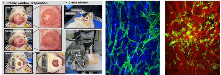 Cranial window 장착 과정(왼쪽) 및 2-photon intravital brain imaging(가운데, 오른쪽) 가운데 영상내의 blood vessels(GFP), tumor(BFP), 오른쪽 영상내의 macrophages(GFP), blood vessels(Tomato) Luiz H. Geraldo. et al., J Clin Invest, 2021