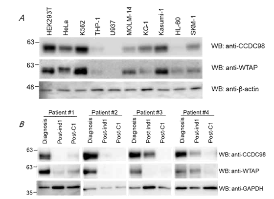 AML 세포주 및 환자 시료에서 WTAP-CCDC98 발현량 상관관계 분석
