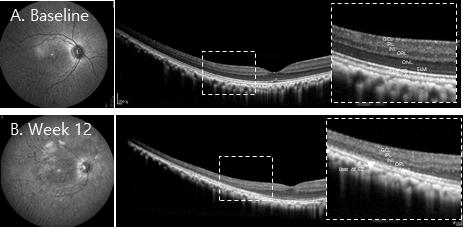 약물유도 마카크 원숭이모델 망막의 OCT상 황반부 주위 시세포 손실과 주변망막 두께 감소 관찰 (MNU 약물처리 전 vs. 2 mg/ml 약물처리 후 12주경과)