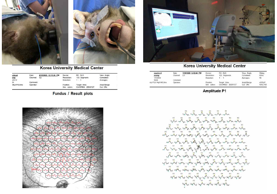cynomolgus 원숭이에서 시행한 다초점 망막전위도 검사. 레이저 검안경 기능을 통해 망막내에 국소 망막 전위도와 해부학적 위치를 같이 연관지어 확인해 볼 수 있는 장점이 있음. 레이저 검안경기능을 통한 황반부위에 가장 큰 진폭을 지니는 파형을 확인할 수 있음