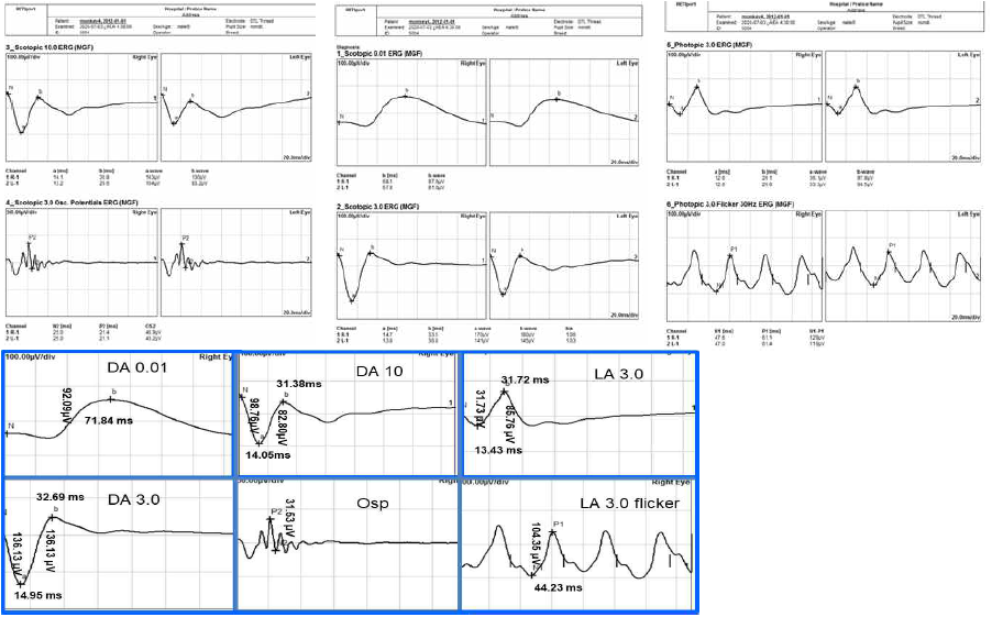 . cynomolgus 원숭이에서 시행한 전체망막전위도 검사. 사람의 전체망막전위도 검사와 모양에서 놀라운 유사성을 보임 암순응 0.01 에서 b-파장의 도달 시간 (implicit time)은 71 millisecond였고, 암순응 3.0에서 a 파장 도달시간은 14, b 파장 도달시간은 32 msecond였음. 진동소파전위 전폭은 31uV, 명순응 a, b 파장의 도달시간은 각각 13, 31 msecond였음