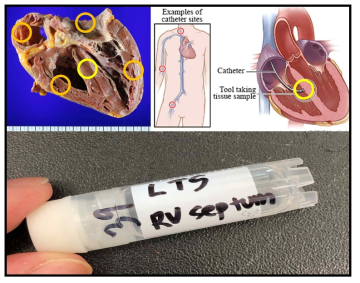 심장 조직의 채취 (하단). 심장이식 조직의 경우 좌심방, 우심방, 좌심실, 우심실의 조직을 채취하고 우심실 중격부의 조직을 추가로 채취 (좌측 상단). 심근내막 조직 검사의 경우 우심실 중격부 조직을 1mm x 1mm 크기 이상으로 획득하여 분석을 시행함 (우측 상단)
