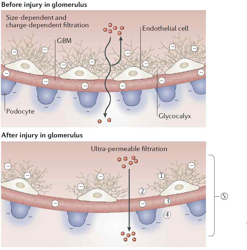 사구체 질환이 사구체를 가로지르는 Nano particle 수송에 미치는 영향에 대한 모식도