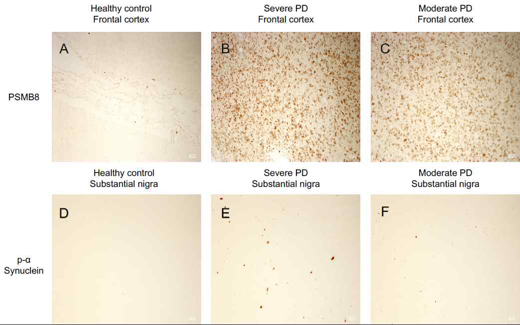 파킨슨병 환자의 뇌에서 PSMB8 expression 이 매우 증가되어 있음