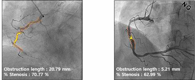 촬영된 CAG중에서 % Stenosis 50인 abnormal case 예