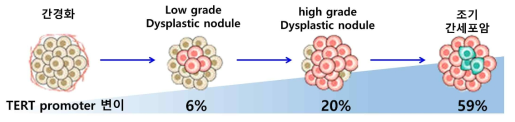 TERT promoter 변이정도에 따른 간세포암의 초기진행