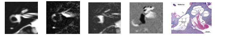 본 연구팀이 촬영한 내이 MRI 영상과 조직학적 예시. 좌측부터 MRC, PPI, PEI, Hydrops-Mi2 영상으로 Hydrops-Mi2 영상에서 보이는 까만 부분(흰색 화살표)이 우측 예시의 내림프수종을 정확히 보여주고 있음