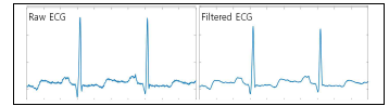 전처리 필터 전/후 ECG 신호. 필터링 후 노이즈 성분이 제거됨.