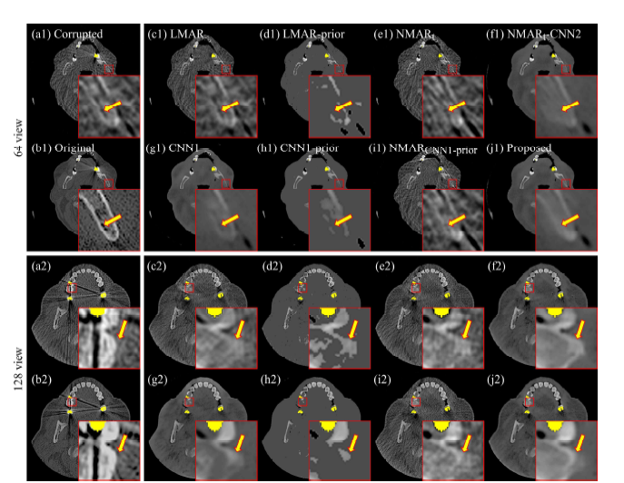 실제 금속 인공음영을 가지는 임상 데이터셋에서의 금속 인공음영 보정 결과 (a) 실제 금속 인공음영을 가지는 영상을 희박 샘플링으로 복원한 영상, (b) 실제 금속 인공음영을 가지는 원본 영상, (c) 선형 보간법 금속 인공음영 제거 영상, (d) 일반 prior 영상, (e) 일반 prior 영상을 활용한 정규화 선형 보간법 금속 인공음영 제거 영상, (f) (e)결과를 CNN으로 잔존 에러를 보정한 영상, (g) 선형 보간법 기반 영상을 CNN으로 보정한 영상, (h) 개선된 prior 영상, (i) 개선된 prior를 활용한 정규화 선형 보간법 금속 인공음영 제거 영상, (j) 최종 제안한 방법으로 실제 금속 인공음영을 보정한 영상.