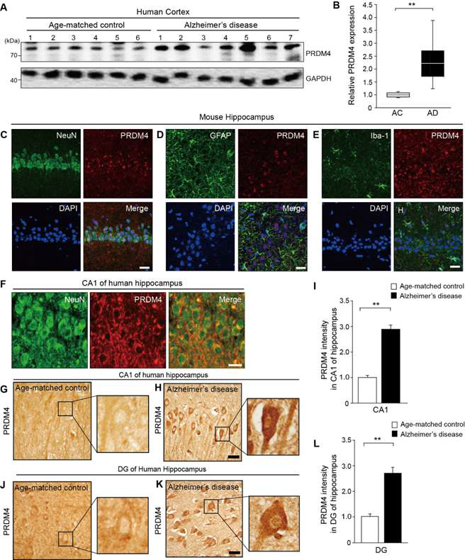 치매환자의 대뇌피질 조직에서의 PRDM4 단백질이 정상인보다 발현이 높은 것을 immunoblot 실험 방법으로 확인함. (A, B)Immunolot 을 통해서 PRDM4 단백질이 치매환자 대뇌피질에서 정상인보 다 높게 발현 되고 있음을 확인함. (C-E) Immunohistochemistry를 통해서 PRDM4 단백질이 마우스 hippopcampus의 신경세포 (C)에서 발현 되고 있음을 확인함. astrocyte, 미세 아교세포 (D), microglia, 교세포(E)에서는 PRDM4 가 발현 되지 않음을 확인함. (F)Immunohistochemistry를 통해서 PRDM4 단 백질이 사람의 hippopcampus의 신경세포에서 발현 되고 있음을 확인함.(G, J)치매환자의 대뇌피질 조직 에서의 PRDM4 단백질이 정상인보다 발현이 높은 것을 Immunohistochemistry 실험 방법으로 확인함.