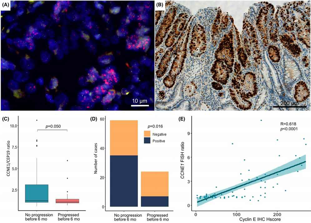 Fluorescence in situ hybridization (FISH) and immunohistochemistry (IHC) of cases with CCNE1 copy number gain. All cases with CCNE1 copy number gain were tested for and confirmed positive by both CCNE1 FISH (A, ×1000) and IHC (B, ×200). Significantly higher CCNE1 gene amplification by FISH CCNE1/CEP19 ratio (C) and Cyclin E protein expression (D) were observed in patients who did not progress before 6 months than those who did (p = 0.050 and 0.016, respectively). The CCNE1 FISH ratio and IHC showed good positive correlation (r = 0.68, p < 0.001). (E) p-value by Mann–Whitney test and Fisher-exact test. Correlation coefficient rho (R) by Spearman rank correlation. Mo, months.
