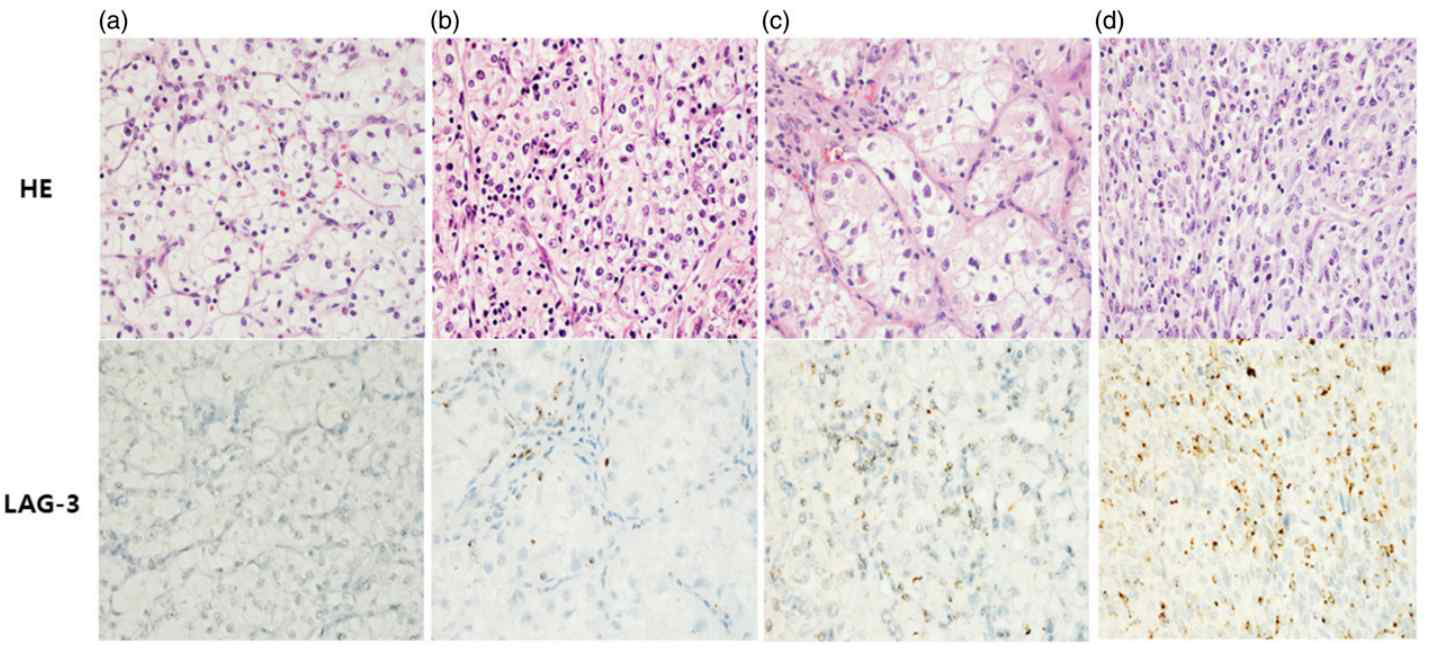 Expression of LAG-3 by immunohistochemistry according to Fuhrman nuclear grade of clear cell renal cell carcinoma. Fuhrman grade 2 (a), grade 3 (b), grade 4 (c), sarcomatous differentiation (d). Original magnification, ×200.