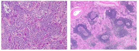 Lymphocyte-rich subtype hepatocellular carcinoma (H&E)