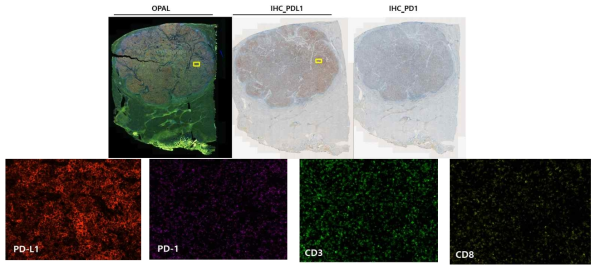 OPAL images for PD-L1, PD-1, CD3 and CD8 in lymphocyte-rich subtype hepatocellular carcinoma