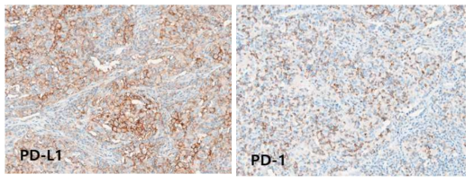 Images of immunohistochemical staining for PD-L1 and PD1 in lymphocyte-rich subtype hepatocellular carcinoma