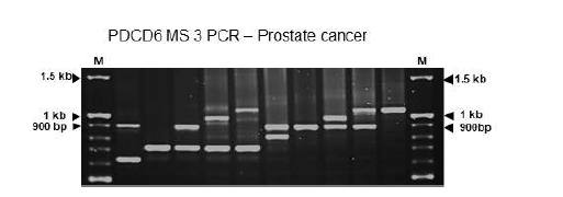 PDCD6-MS3 전립선암 환자에서 패턴 분석