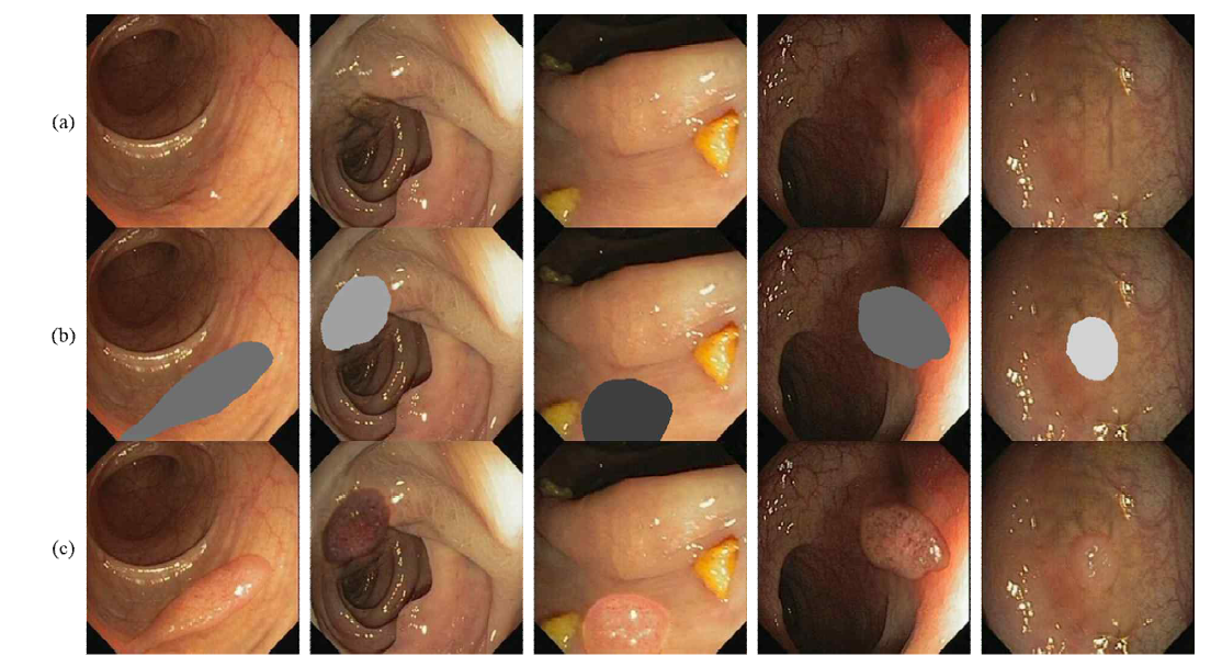 제안하는 방법으로 생성된 새로운 용종 이미지 프레임 예시. (a) 용종이미지를 정상이미지로 변환한 이미지 예시, (b) 정상이미지에서 용종이미지를 생성하기 위한 입력 조건을 결한한 이미지 예시, (c) 입력 조건 (b)를 사용하여 생성된 새로운 용종 이미지 예시