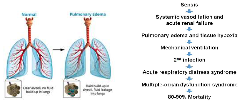 Pulmonary edema in sepsis