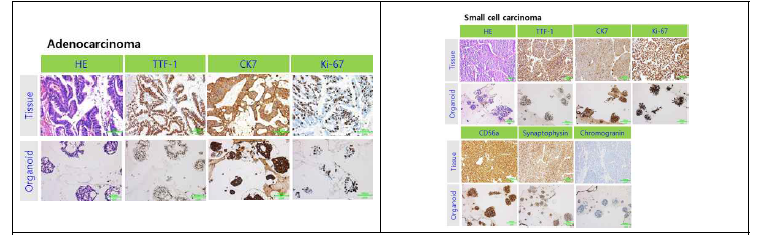 환자 조직 유래 종양 오가노이드 면역 염색 비교