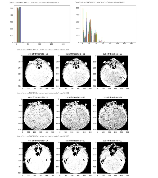 환자마다 다른 pixel distribution과 Threshold 변화에 따른 혈관 label