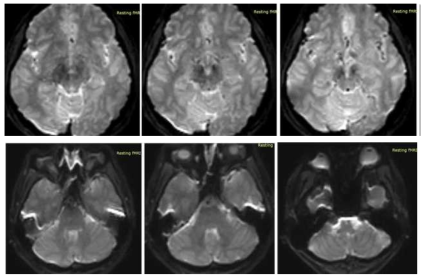 개선작업 후 fMRI scan 결과