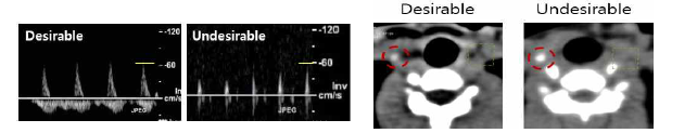 이상혈류 유도 부위 경동맥의 back and forth 초음파 결과와 해당 부위 (빨간색 동 그라미) 에 조영제를 담지한 리포좀의 신호가 증가함을 확인한 CT 결과