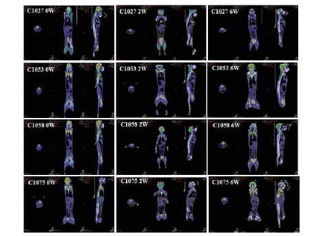 만성설사증 분변이식 개체의 영상의학적 (18FDG PET-CT) 분석결과