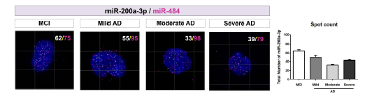 액체생검 miRNA 초고해 상도 이미징 기술 결과들. 치매 환자의 질병 진행에 따른 혈액 내 miR-200a-3p (white), miR-484 (magenta), DAPI (blue) 발현 이 미지와 3D rendering을 통한 spot counting.