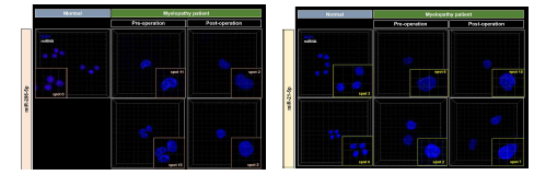 새롭게 개발한 miRNA biopsy 기술을 적용하여 Myelopathy 환자의 혈액 세포 내의 miRNA 이미징. (좌) 핵 (DAPI, Blue), miRNA-206-5p (White), (우) 핵 (DAPI, Blue), miRNA-21-5p (White)를 고해상도 삼차 원적 이미지 및 rendering을 통해 정량화
