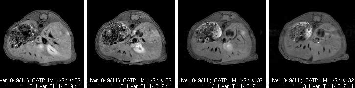 Rt. aravertebral muscle에 OATP1B3 DNA injection후 초음파로 유전자 전달을 시행한 후 gadoxetic acid enhanced MRI를 촬영시 매우 미약한 정도의 조영증강 효과만 보임.