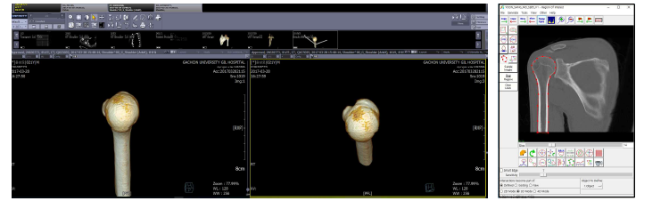 PACS에서 상완골의 4개 구조를 구현할 수 있는 영상 데이터 검토 및 선별, ROI
