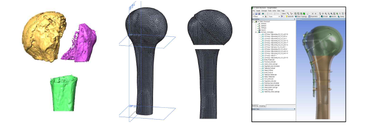 2가지 타입의 유한요소 골절 model 개발 : 3-Parts fracture(Surgical neck / Greater tubercle / Body), Medial gap fracture