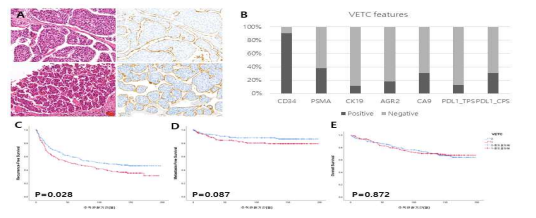 VETC feature를 보이는 간암의 특성. (A) VETC의 HE 염색과 CD34에 대한 면역염색의 모습 (200배) (B) VECT를 보이는 간암의 마커 발현 분율. VECT를 보이는 경우의 (C) recurrence-free survival (D) metastasis-free survival과 (E) overall survival 분석 그래프
