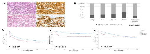AGR-2의 발현. (A) HE 염색과 AGR-2 면역염색 소견 (200배) (B) 전이한 장기별 AGR-2가 발현한 정도 (코호트 3). AGR-2 발현 케이스의 (C) recurrence-free survival (D) metastasis-free survival (E) overall survival 분석 그래프. (코호트 1)