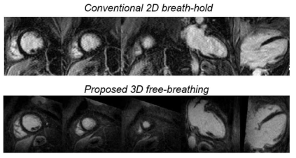 : 고식적인 breath-hold 2D multi-slice 기법과 제안하는 자유호흡 3D 기법 인체 테스트 비교