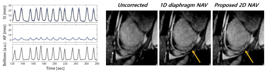 왼쪽: S/I, A/P 방향의 호흡 움직임 측정 결과. 오른쪽: 자유호흡중 얻은 무보정, 고식적인 1D 움직임 보정, 제안하는 2D 움직임 보정 심장 영상