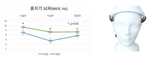 수술 전 뇌파 검사 결과 (median fre quen cy), 수술 전후 비침습적 2채널 뇌파검사 기기