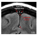 MRI에서 뇌정맥동 주변에서 뇌막 림프관이 관찰됨 (Absinta et al., 2017)