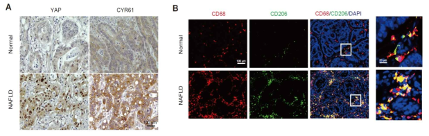 지방간 전이암 환자에서 YAP 활성화 및 M2 대식세포 증가