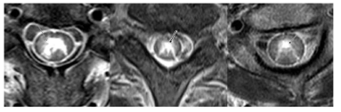 감별 진단에 도움이 되는 MRI 상 brighter spotty lesion 소견 (4)