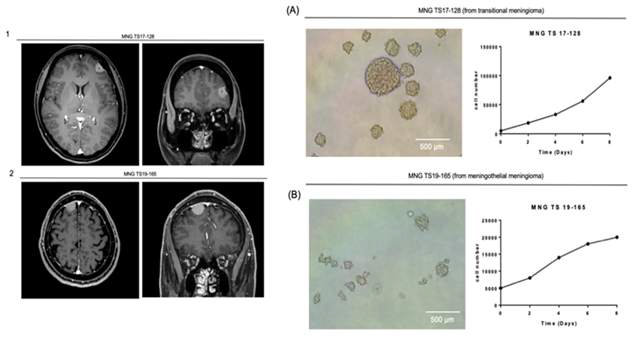 meningioma 환자의 임상적정보 및 종양구세포의 세포성장능 확인