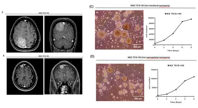 meningioma 환자의 임상적정보 및 종양구세포의 세포성장능 확인