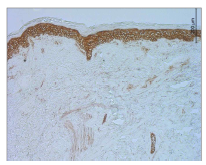 염증성 피부병변에서 EGFL6의 발현. 비특이적 염색 을 보이는 표피를 제외하여 상 부진피에 혈관주위 EGFL6 발 현세포가 확인됨.