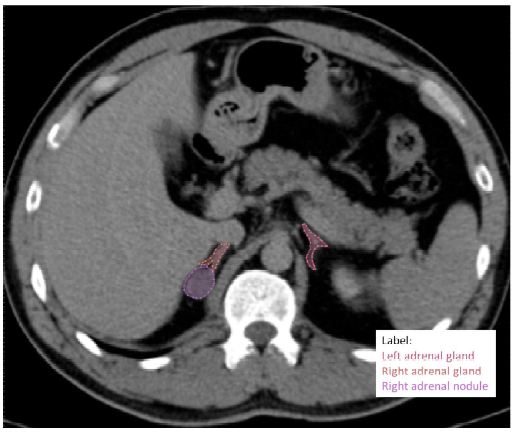 부신/부신결절 라벨링 예시