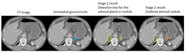 딥러닝 알고리즘을 적용한 부신종양 검출의 실제