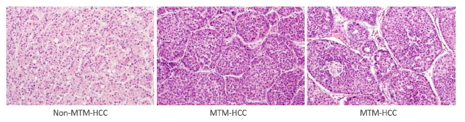 Macrotrabecular-massive HCC (MTM-HCC)의 병리 소견